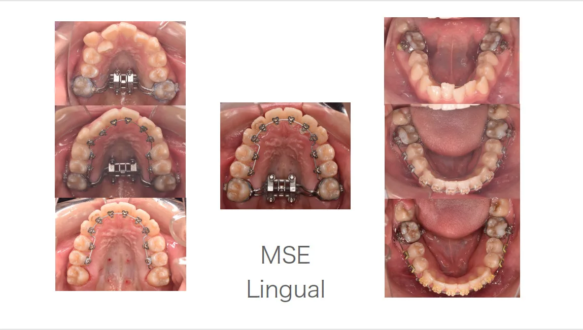 MSE(上顎拡大）+リンガル矯正